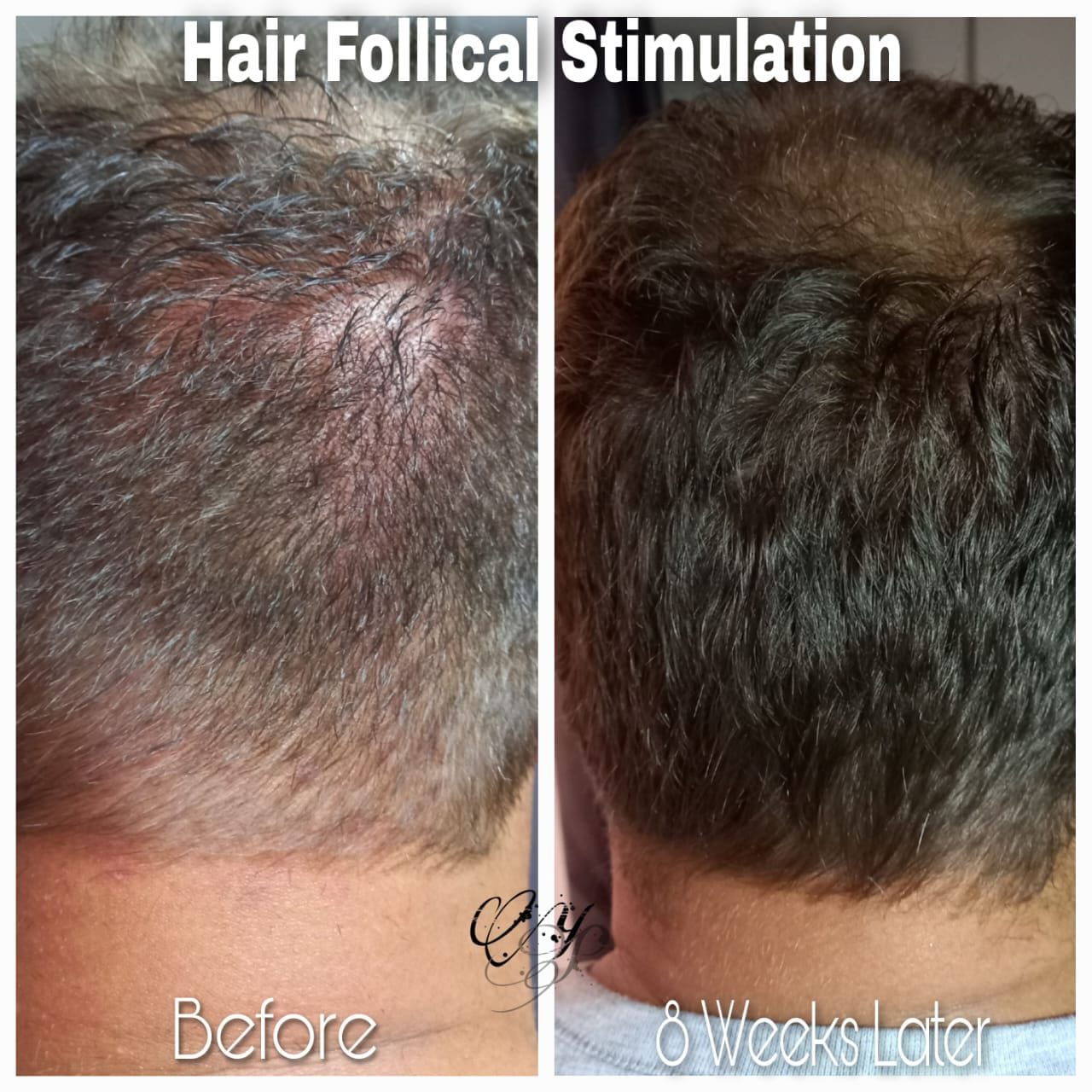Before and after — Follicular Stimulation