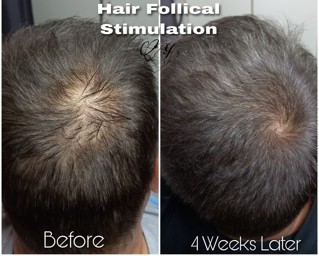 Before and after — Scalp Health Improvement