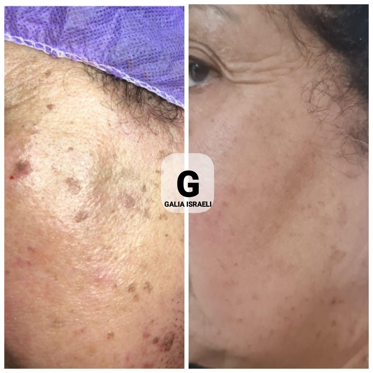 Before and after — Sun Damage Appearance