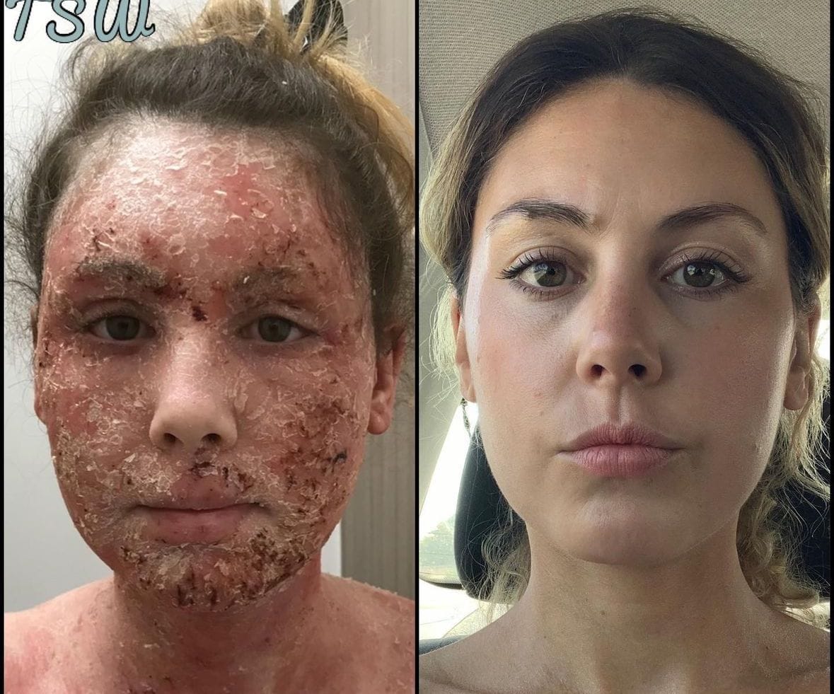 Before and after — Skin Recovery & Rejuvenation