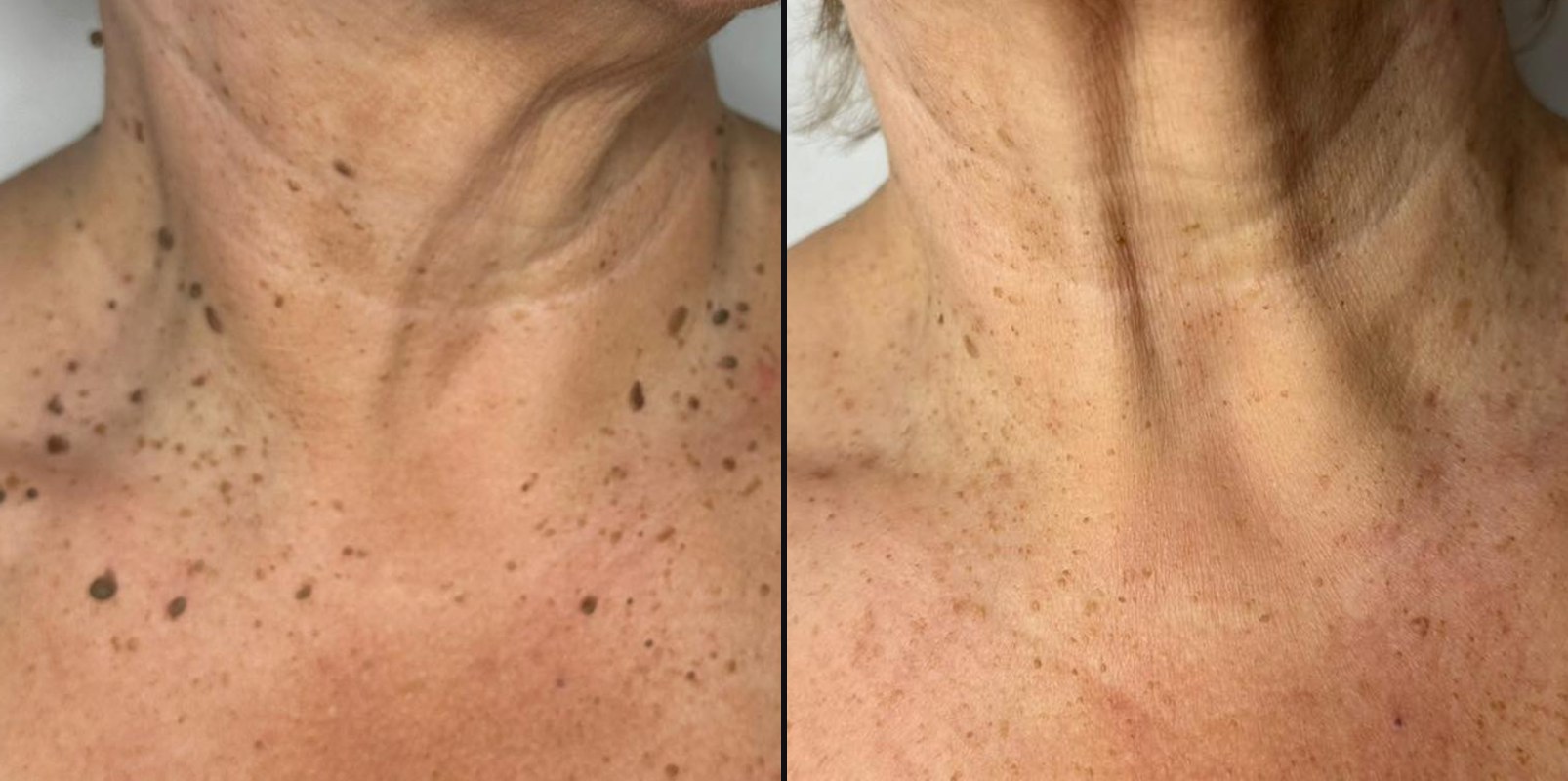Before and after — Lesion Removal