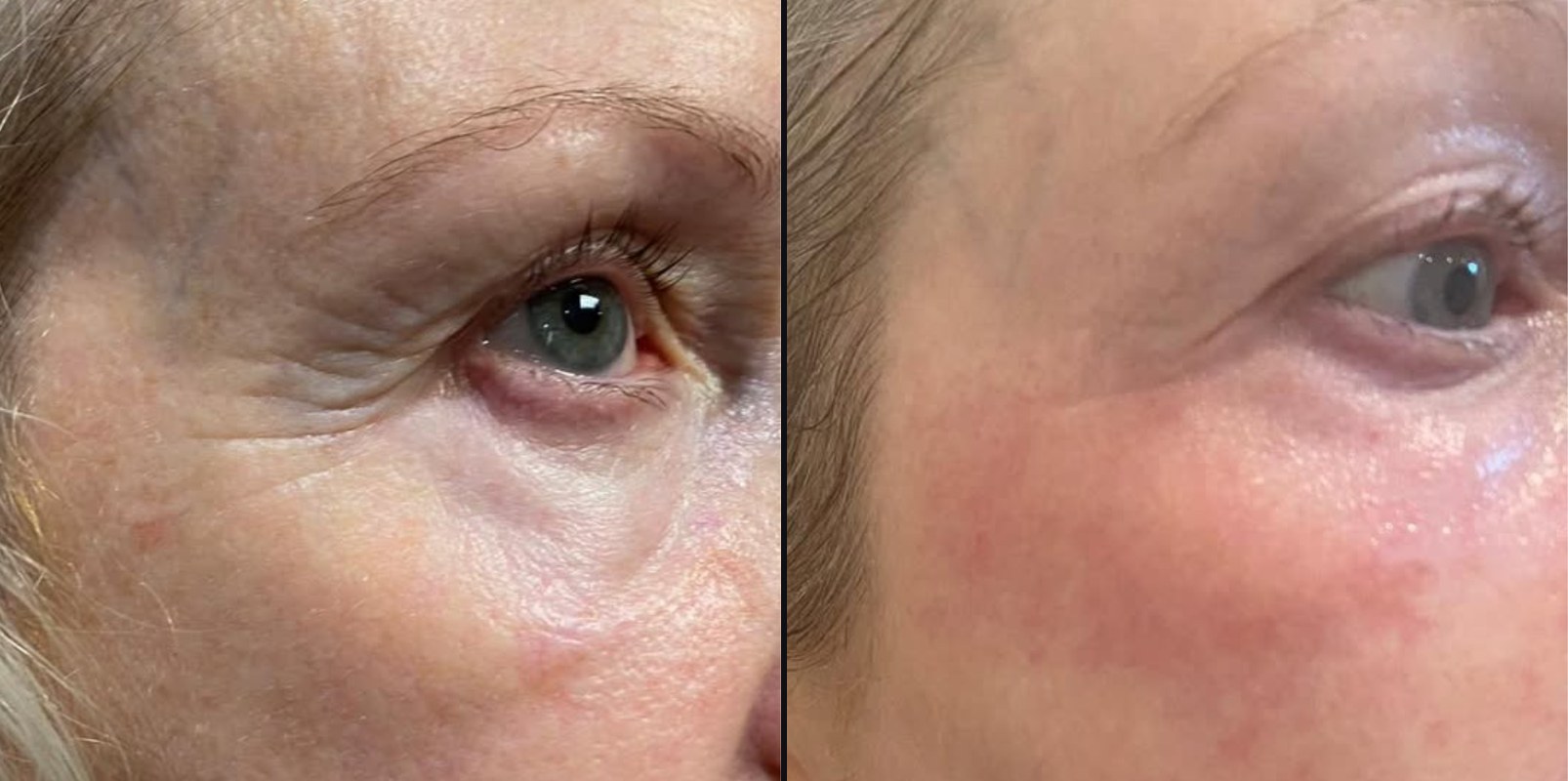 Before and after — Skin Lifting & Tightening